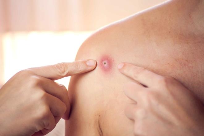 MAYMUN E VRSNN BELRTLER NELER?    Hastalk yksek ate, ba ars ve kantyla balyor. Terleme, srt ve kas ars, halsizlikle seyrediyor. Dkntler genellikle nce yzde grlyor, sonra vcuda yaylyor.