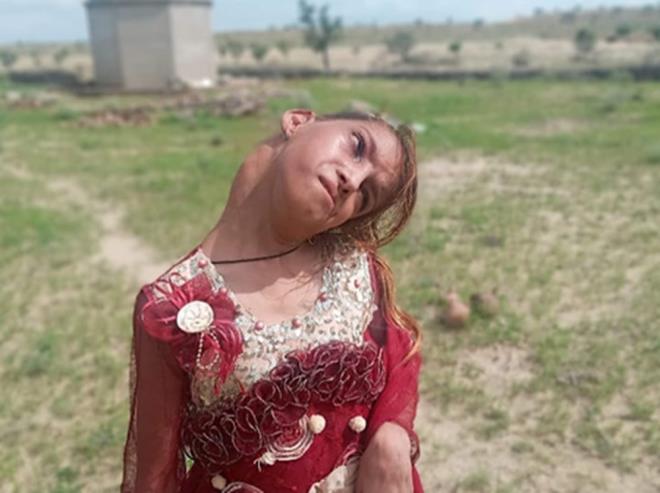 nk, daha 10 aylkken ailesinin evinin balkonunda ablasnn kolundan dt. Yaad talihsiz kaza Gul?un boynunu 90 derece bkk brakt. Ailesi onu defalarca doktora gtrd, baz ilalar kulland ve destek iin boynuna bir kemer takld. Ancak, tm bunlarn ardndan kk kzn durumu daha da ktleti.