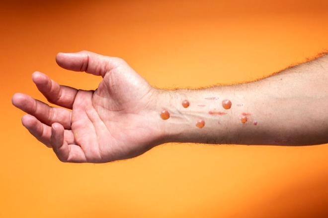 MAYMUN E BELRTLER NELER?<br>    Klinik tablo, ate, youn ba ars, lenf dmlerinin imesi, srt ars, kas arlar ve youn halsizlik ile balar.    Bu bulgular ilk 5 gn n plandadr. Deri dknts genellikle atein ortaya kmasndan sonraki 1-3 gn iinde balar.  <br>  AVULAR VE AYAK TABANLARI  <br>  Vakalarn yzde 95?inde ellerin avularn ve yzde 75?inde ayak tabanlarn etkiler. Genital blge ve kornea da etkilenir.    Klinik tabloda baz kiilerde a hassasiyet, me, terleme de grlebilir.