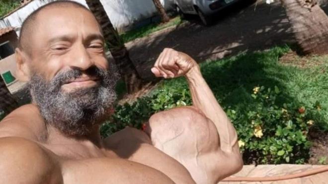SYNTHOL NEDR?    Synthol, ya, benzil alkol ve lidokain karmndan oluuyor. Salk uzmanlarnn bildirdiine gre madde "sinirlerde hasar, pulmoner ya embolisi, pulmoner arter tkankl, miyokard enfarkts, beyin felci ve enfeksiyona" neden oluyor.