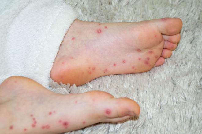 DOMATES GRBNN TEDAVS VAR MI?    lmcl olmayan Domates Gribi'nin herhangi bir as veya tedavisi bulunmuyor. Uzmanlar Domates gribi virsne kar en etkili tedavinin bol sv almak ve istirahat etmek olduunu belirtiyor.