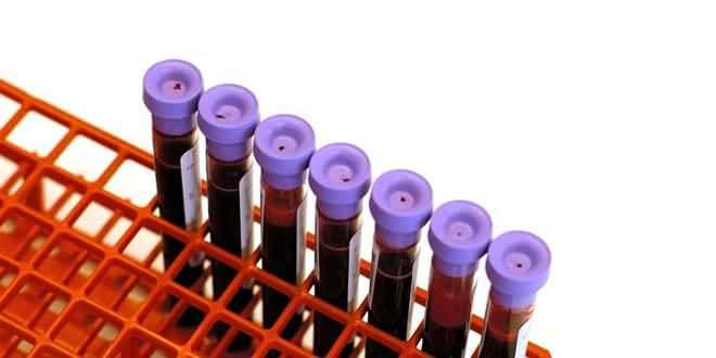 Getiimiz yllara gre fel olan insan saysnn arttn syleyen Nroloji profesr ve almann ba aratrmacs Dr. Steven Kittner, "A kan grubunun neden daha yksek bir risk oluturduunu hala bilmiyoruz, ancak bunun byk olaslkla kan damarlarn oluturan trombositler ve hcreler gibi kan phtlama faktrleriyle ve ayrca tm bir rol oynayan dier dolamdaki proteinlerle bir ilgisi var. Kan phtlarnn geliiminde rol oynar" dedi