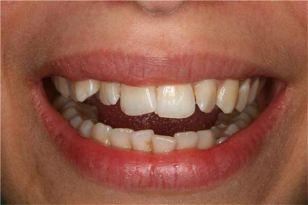 Siz farkna varmadan hizas bozulan diler psikolojik adan da sizi etkileyecektir. Yanl hizlanan diler ise ilerleyen zamanda; ba ve ene arsna neden olabilirler. yice arpklamaya balayan dilerin temizlenmesi zorlanr ve buda rmeye zamanlada di kaybna neden olur.