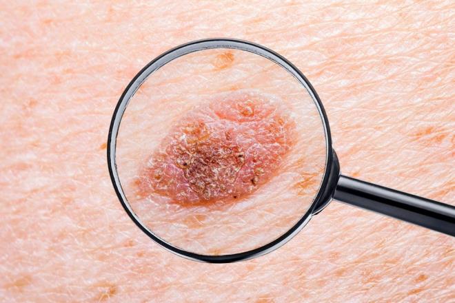 Tm hastalar melanomlarnn karlmas iin ameliyat oldu. Aratrmaclar, bu tmrlerin biyopsisini yapt ve genetik olarak sralad, ardndan her hastann baklk sisteminin tanmas iin mRNA biiminde yaklak 30 adet genetik, kiiselletirilmi tmr iareti belirledi.