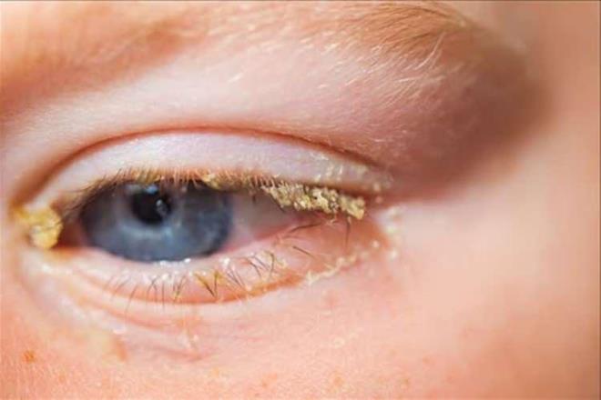 Gznz apak m yapyor?  <br>  Kaynam ay bir kaba koyarak buhar gznze gelecek biimde banz stne koyun. Veya lk aya batrlm pamuu gzlerinize tatbik edin.