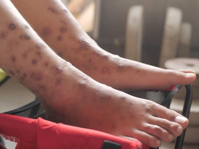 Dr. Navalkele, "Kolonizasyon, mantarn sessiz bir taycs olabileceiniz anlamna gelir ve daha sonra aktif bir enfeksiyon olabilir. Kolonize olarak tanmlanrsanz, salk ekibinizin bunu bildiinden emin olmalsnz, bylece derhal izolasyon nlemlerine balayabilir ve enfeksiyondan phelenildiinde uygun tedaviyi balatabilirler."