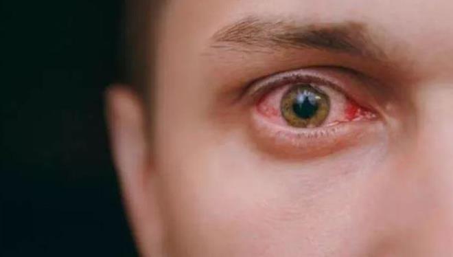 Op. Dr. kran Evren Kaplan, "Viral konjonktivit, bakteriyel konjonktivit ve alerjik konjonktivit hastaln balca trleridir. Tedaviyi belirlerken bu trlere bakarak bir tedavi dzenlenir. Viral konjonktivitlerin spesifik tedavisi yoktur. Genellikle hafif ikayetlerle geirilir. Hastalara pomat, gz damlas ve souk kompres nerilir. Bakteriyel konjontivit vakalarnda enfeksiyonun gemesi iin antibiyotik ieren damla ve pomatlar kullanlr.