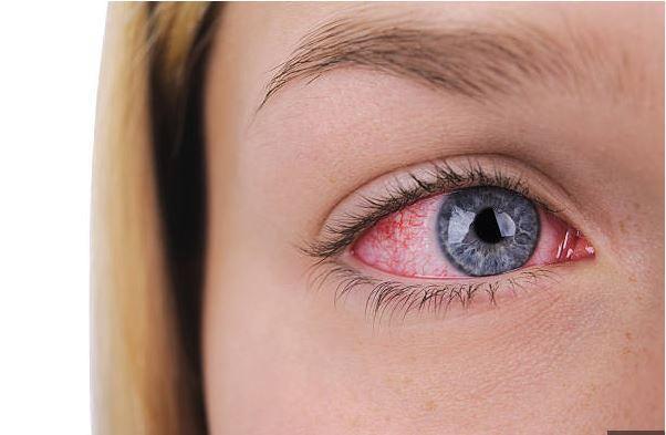 Damla ve pomatlarn bir hafta boyunca dzenli kullanlmas durumunda, hastalarda iki haftadan daha ksa srede iyileme grlr ve hastaln bulacl azalr. Alerjik konjonktivit tedavisinde ise nce hastaln sebebi belirlenir. Ardndan belirtilerin hafifletilmesi ve ortadan kaldrlmas iin gz damlas ve alerji kart ilalar kullanlr. Konjonktivit tedavi edildiinde gzde hasar brakmadan iyileebilir fakat tedavide ge kalnmas durumunda gzde ciddi hasarlara neden olabilir." dedi.