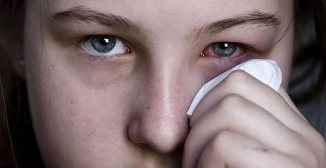 Fakat en yaygn ve bilinen belirtisi gz aknn kzarmasdr. Genellikle iltihaplanmaya bal grlen bu kzarklk, gz damarlarnn imesi ve sonrasnda dem olumasndan kaynakl yaanr. Gzde kalc hasar yaanmasn nlemek iin doktor mdahalesi byk nem tar."