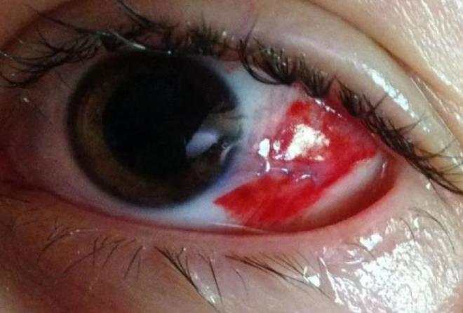 EN YAYGIN BELRTS GZLERDE KIZARIKLIK    Virsn belirtilerinin hastaln trne gre deiiklik gstereceini syleyen Kaplan, unlar ekledi: "Hastalar gzde iddetli kzarklk, kant, ar, sulanma, gzlerde apaklanma, a hassasiyet, kirpiklerde iltihaplanma ve gz kapanda ilik gibi ikayetlerle bavurulabiliyor.