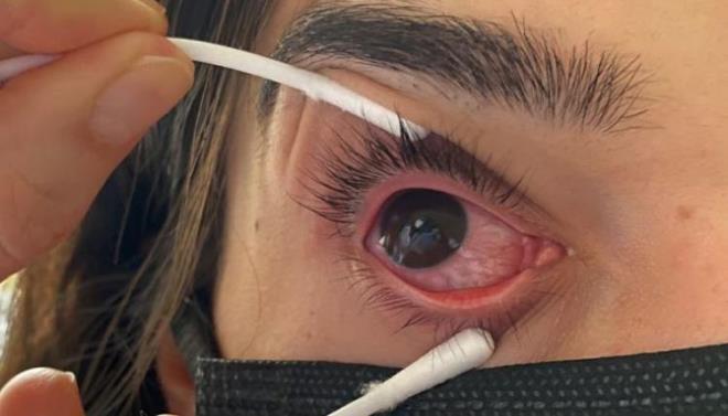 Szlerine yle devam eden Kaplan, "Hijyene dikkat edilemeyen alanlar, toplu tamalar, okullar, kreler, hastane ve yal bakmevleri gibi toplu olarak bulunulan ortamlarda bulama hz yksektir. zellikle de kre ve anaokulu gibi kk ya gruplarnda yaylma hz daha yksektir. eitli zeminlerde ve solsyonlarn ierisinde lens solsyonu vb. gibi, uzun sre stabil kalabilirler. Fiziksel ve kimyasal etkenlere direnli olmalar nedeniyle uzun sre enfekte etme zelliklerini korurlar ve yaylma riski tarlar. Adenovirsler, oda scaklnda haftalarca canllklarn koruyabilmektedir." ifadelerini kulland.