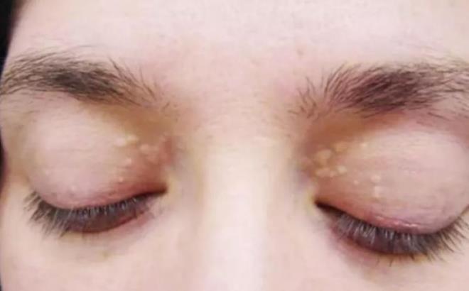 GZ EVRESNDEK BELRTLERE DKKAT    Yksek kolesterol'n belirtilerini syleyenAmbani, "Yksek kolesterol, ksantelazmaya, gz evresinde kk sar yal tabakalara neden olabilir.