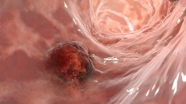 Fransz bilim insanlar, karncalarn insanlarn idrarndaki kanser kokusunu alglayabildiini kefetti.      Daha nce, birka kanser trnn idrar kokusunu deitirdii bulunmutu ancak uzmanlar ilk kez karncalarn bu yetenee sahip olduunu ortaya kard.