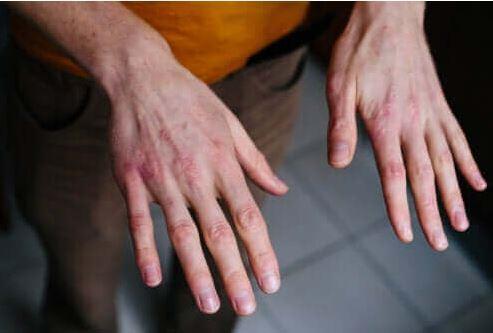 "Kulak memesinde izgi olanlarda kalp damar hastal ve fel geirme olasl yksek kabul ediliyordu. Bu izgi her iki kulakta da bulunuyorsa riskin daha yksek olduu dnlyordu.