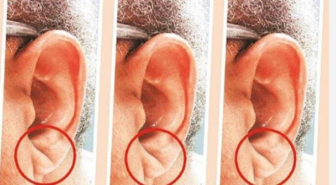 KULAK ZGS ERKEN BELRT     Eskiden koroner arter hastalnn vcuttaki deiimlerle takip edildiini aktaran Prof. Dr. Boztosun, unlar kaydetti;