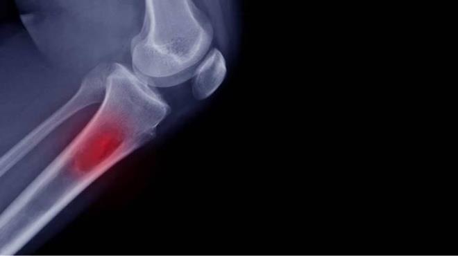 OSTEOD OSTEOMA KEMK TMR NEDR?    Osteoid osteoma kemiin iyi huylu tmrdr ve iyi huylu kemik tmrlerinin %10?unu oluturur. ocukluk ya grubunda daha sk grlr. Erkeklerde kadnlara oranla 2-3 kat daha fazla grlr. Genellikle uzun kemikleri tutar (kaval kemii, uyluk kemii, kol kemikleri). Dier kemiklerde de nadir olarak grlmesi mmkndr.