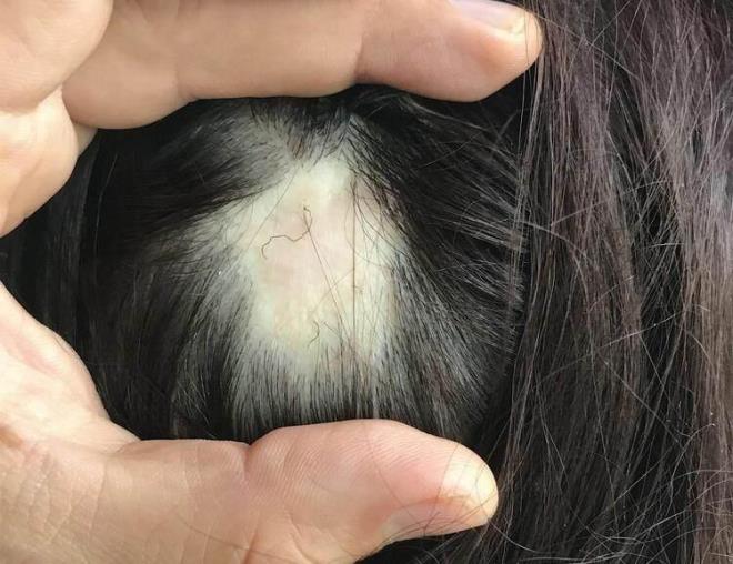 O blgeye sarmsak, jilet gibi yntemlere bavurmadan, kendi kendine veya hekimin uygun grecei tedavilerle iyilemesini temin etmek gerekir. Eer altta yatan bir stresi varsa ocuun bu adan ocuu ruh sal uzmanna ynlendirmek nemlidir? eklinde konutu.