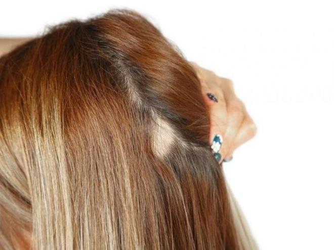 Sa dklmesi ile bazen sakran eklinde de karlatklarn syleyen Dr. zden, ?Sakran bazen aniden san tamamen salkl olduu anda sal deride bir kayp olarak karmza kar. Sakran ocuklardan bir strese bal olabilecei gibi alta yatan bir tiroit hastal bazen demir eksiklii anemisi gibi bir hastaln bulgusu da olabilir. Bu nedenle bir dermatoloji uzman tarafndan grlmesi ok nemlidir. Sakran ok iyi huylu bir hastalktr.