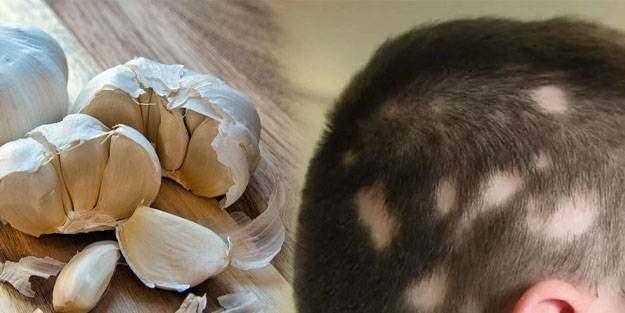 Ondokuz Mays niversitesi (OM) Tp Fakltesi Dermatoloji Ana Bilim Dal retim yesi Prof. Dr. Mge Gler zden, kellikle mcadele ve sakran hastalnda kullanlan tedavi yntemleri hakknda bilgilendirmelerde bulundu.