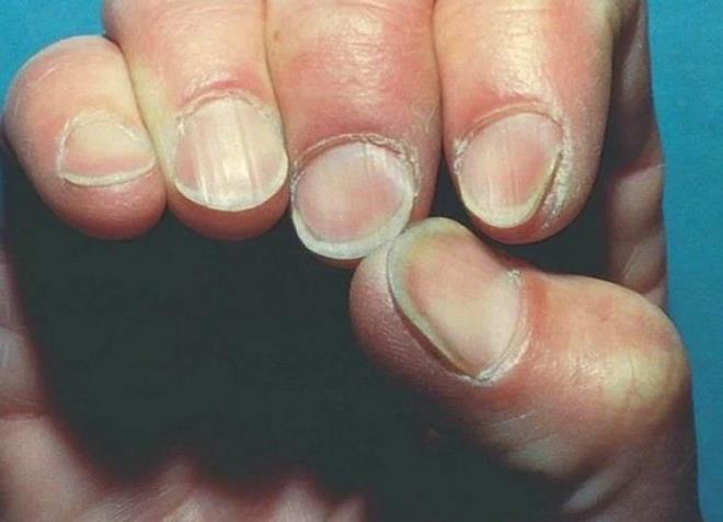 Trnak bakmnn dzenli yaplmas gerektiini belirten Dr. zlem Apti Sengkioun, zellikle du ve banyo sonras yumuak bir trnak fras ile temizlenmesini neriyor.