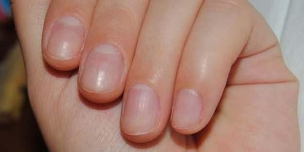 Koyu krmz dikey izgiler:<br> Kalp kapak hastalklarnda grlebilir.  <br>  Yeil trnak:<br> Psdomonas olarak adlandrlan bakterilerin enfeksiyonu sonucu grlebilir.  <br>  Siyah trnak: <br>Trnak mantar ve birtakm ilalarn kullanmna bal olabilecei gibi melanom olarak isimlendirilen ok tehlikeli bir deri kanserinin ilk bulgusu olarak da ortaya kabilir.