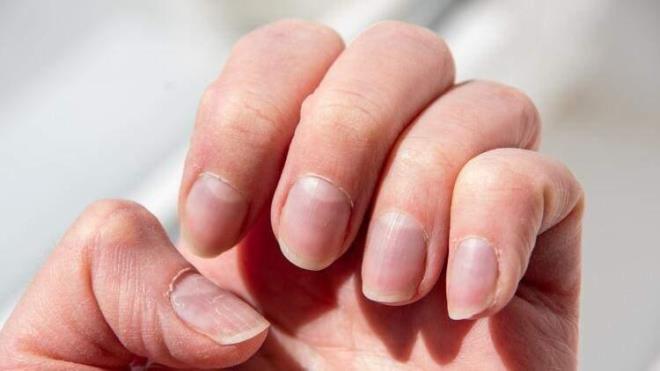 Trnaklardaki belirtiler hangi hastalklarn sinyali olabiliyor?  <br>  Dermatoloji Uzman Dr. zlem Apti Sengkioun, trnaklardaki deiikliklerin baz hastalklarn sinyalini verebildiini belirterek, o deiiklikleri ve hastalklar yle sralyor;