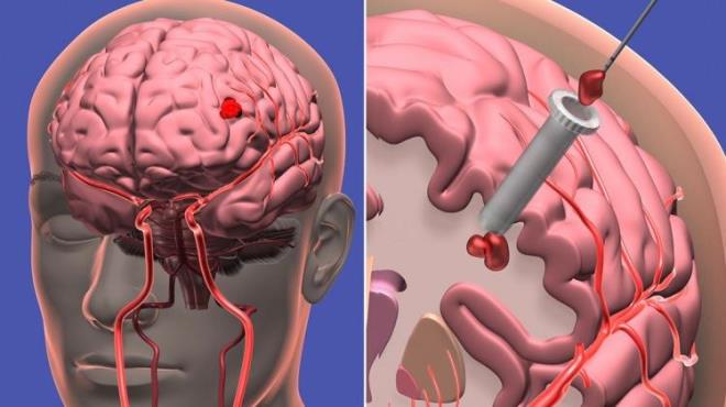 Son zamanlarda beyin kanamas vakalarnn arttn belirten uzmanlar beyin kanamasnn en sk sebebinin travma olduunu sylyor.  Travma olmakszn gelien spontan beyin kanamalar grlebileceini de belirten uzmanlar , protein yerine karbonhidrat arlkl beslenmenin ise beyin kanamas riskini arttran sebepler arasnda olduunu ifade ediyor. Peki beyin kanamasn riskini artran yiyecekler neler?