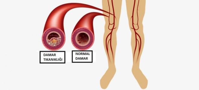 Damar tkankl, bir kan damarnn genellikle damar sertlii ya da bir pht nedeniyle tkanmasdr. Tkankla neden olan pht, sklkla damarlarda aterosklerotik plaklar nedeniyle daralm blgelerde geliir.