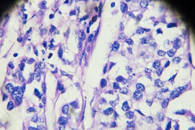 Bilim insanlar, bu durumun ayrca yapay zekann dier kanserleri erken tehis etme potansiyelini de gsterdiini syledi. Uzmanlara gre bilgisayarlar byk miktarda bilgiyle beslenebilir ve tahminlerde bulunmak, sorunlar zmek ve hatta kendi hatalarndan ders karmak iin bu bilgilerdeki rntleri tanmlamak zere eitilebilir.