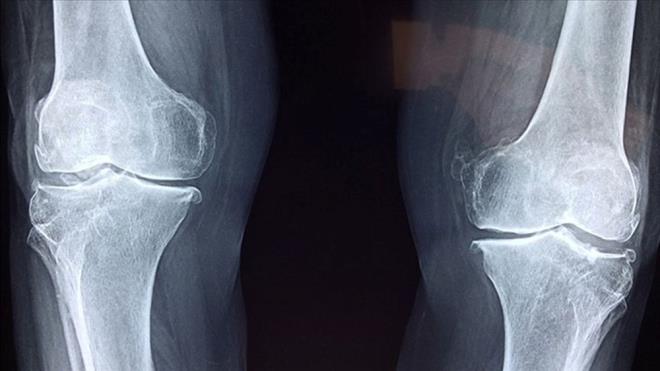 ARTR�T �NLENEB�L�R M�?<br>    Artrit, eklemlerde v�cut taraf�ndan �retilen bir iltihapt�r. Bu iltihap mikrobik de�ildir, v�cut taraf�ndan �retilir. Artrit tek bir hastal�k de�ildir, 100?den fazla farkl� hastal�k artrit ile ili�kilidir ve iltihapl� eklem a�r�s�na neden olur.    A�r�l�, sert veya �i�mi� eklemler ya�l� yeti�kinler aras�nda yayg�n bir �ikayettir ve �o�u i�in bunlar ka��n�lmaz bir te�his gibi g�r�nen artritin ilk belirtisidir.    Kuzey Carolina �niversitesi T�p Fak�ltesi'nden egzersiz fizyolo�u Kelli Dominick Allen, ya�l�l��a ba�l� artritin ka��n�lmaz olmad���n� s�yledi.    �o�u insan i�in ya�l�l�kta artritin �nlenmesi, endi�e verici hale gelmeden y�llar �nce spor veya egzersiz s�ras�nda eklem yaralanmalar�n� �nlenmesine ve ortaya ��kt���nda uygun �ekilde tedavi edilmesine ba�l�.    Sporla ilgili yaralanma riski olmayan ki�iler i�in fiziksel olarak aktif kalmak ve sa�l�kl� bir kiloyu korumak, eklemlerinizin a��r� a��nmas�n� �nlemeye ve ya�am�n ilerleyen d�nemlerinde artrit ortaya ��karsa a�r�y� azaltmaya yard�mc� olabilir.