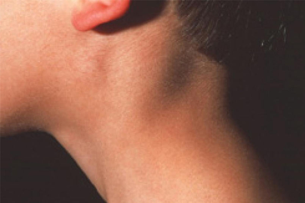 <b>Monon�kleoz:</b> �p�c�k hastal��� olarak bilinen Monon�kleoz, hasta ki�inin �pmesiyle ya da t�k�r���yle bula��yor. En �ok 15-17 ya�lar� aras�nda yayg�n olan hastal�k ayn� yiyecek, i�ecek ve mutfak e�yalar�n�n payla��lmas�yla yay�l�yor. Bu hastal�k ate�e, lenf bezlerinin �i�mesine, bo�az a�r�s�na ve yorgunlu�a yol a�abiliyor