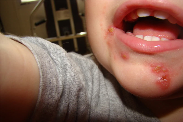 <b>�mpetigo (Okul yaralar�):</b> Bu cilt enfeksiyonuna Streptococcus ya da Staphylococcus isimli bakteri yol a�ar. �ltihap dolu baloncuklar ve a��k yaralarla kendini g�steren bu hastal�k olduk�a bula��c�d�r. Hasta ki�iye, hastal�k bula�m�� y�zeye dokunmakla ya da mikroplar� v�cudunuzun bir b�l�m�nden di�er b�l�m�ne ta��mayla bula��r. Hasta oldu�unu bildi�iniz ki�ilerle do�rudan temas etmeyin, ellerinizi s�k s�k y�kay�n.