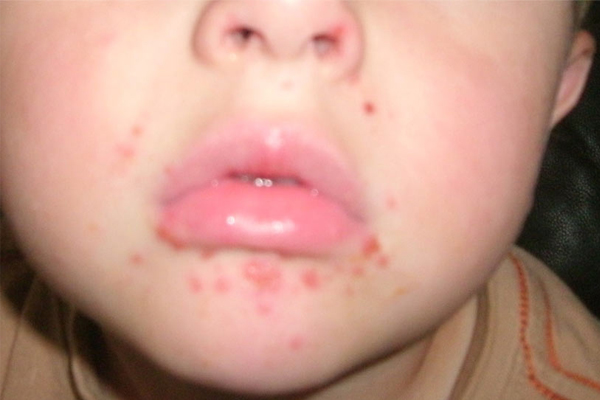 <b>Coxsackie vir�sleri:</b> Bu vir�sler bir dizi hastal��a yol a�abilir. Bunlar�n aras�nda en yayg�n olan� ise a�r�l� olan el, ayak, a��z hastal���d�r. Bu hastal�k a��z i�inde, avu�larda ya da ayak tabanlar�nda k�t� kokulu k�rm�z� kabarc�klara yol a�ar. Tedavisi yoktur, bu nedenle �nleminizi almal�s�n�z. Vir�s t�k�r�kte ya�ar. �ocuklar�n kalem gibi nesneleri a�z�na sokmad���ndan ve ��le yeme�ini arkada��yla payla�mad���ndan emin olun.