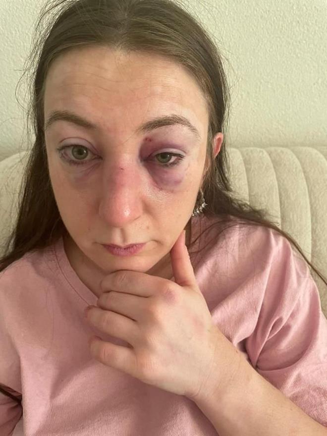 Bursa'da elence merkezinde grd eski sevgilisi Sibel Kahraman' (34) zorla dar karp bindirdii otomobilinde, yzne att 9 kafa darbesiyle yaralayan tutuklu sank rfan ahin'in (51), 9 yla kadar hapis istemiyle yargland davada karar kt.