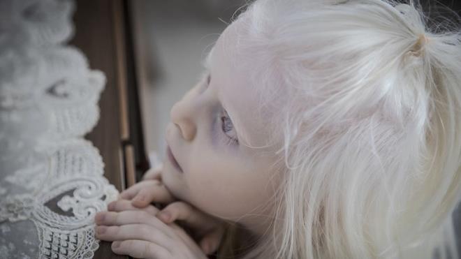 ALBNZM    Albinizm hastalarnda cildimizi, kalarmz, kirpiklerimizi ve gz rengimizi belirleyen ve bunlar renk veren melanin pigmenti bulunmuyor.    Bunun sonucunda birey beyaz bir cilt, beyaz kirpik ve kalara sahip oluyor.    Melanin pigmentinin eksiklii bireyleri gnee kar hassaslatryor, cilt kanserine yakalanma oranlarn ykseltiyor.