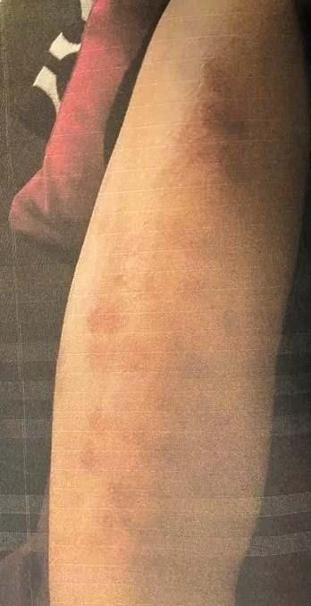 lk olarak gzellik merkeziyle gren lkan'n kzlarnda, ardndan aldklar raporda vcutlarnda ikinci dereceden yanklar olutuu tespit edildi.