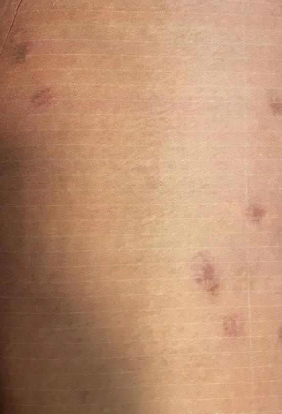 BLRK 'YANIK VAR' DED    Bilirkii tarafndan hazrlanan raporda sz konusu operasyonda Cansu Ceren'in vcudunda birinci derece, Zeynep Seren'in vcudunda ise ikinci derece yanklar olutuunu belirttildi ve gzellik merkezindeki pheliler hakknda 'Taksirle bir kiinin yaralanmasna neden olma" suu kapsamnda ceza talep edildi.