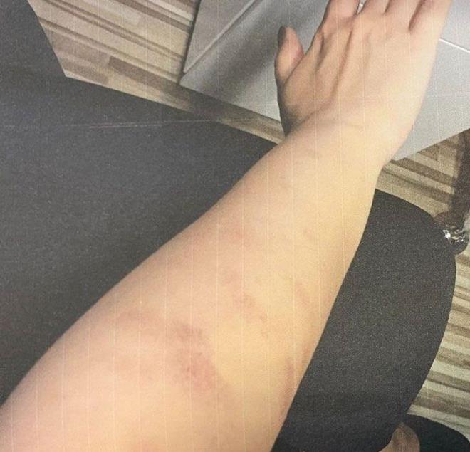 Toplam 16 seans zerinden verilecek hizmetin bedelini pein olarak deyen kardeler 3. seansn ardndan vcutlarnda eitli yank izleri olutuunu fark etti ve soluu mahkemede ald.