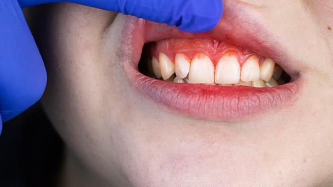 BELRTLER<p>  K vitamini eksikliinin en ciddi sonularndan biri kanamalardr. zellikle K vitamini eksiklii olan bebeklerde, ciddi kanamalar ve kan phtlamasnn bozulmas durumu olan "Vitamin K Yokluu Kanamas" grlr. K Vitamini eksikliinde ciltte kolay rmeler, trnak altnda ortaya kan phtlar, vcut mukoza zarnda meydana gelen kanamalar, koyu renkte ve kan ieren dk, di eti kanamalar ve gzalt morarmalardr.