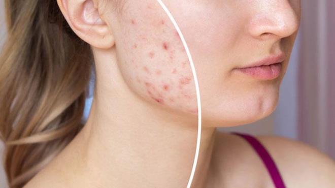 Vitamin eksikli�i nedeniyle ya� bezleri a��r� �al��abilir. Fazla ya� olu�umu cildinizde sivilce ve akneyi art�rabilir. A vitamini eksikli�i belirtileri aras�nda yayg�n bir di�er semptom ise g�z problemleridir. Gece k�rl��� gibi g�z sa�l��� sorunlar�na neden olabilir. Karanl�kta g�rmede g��l�k �ekiyorsan�z doktorunuza dan��mal�s�n�z.