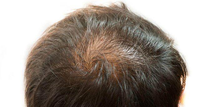 - Salarn incelmesi ve seyrelmesine neden olan dier faktrleri u ekilde sralamak mmkn:    -Hormonal deiiklikler    -Yani doum yapmak    -Baz otoimnun hastalklar    -Zayflam baklk sistemi