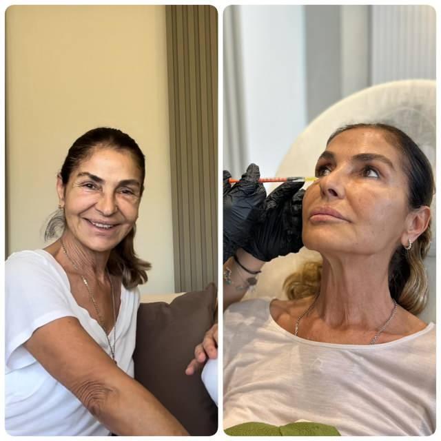 YZN GERDRD    Ameliyatsz bir ekilde yz gerdirme operasyonu yaptran Tuna'nn son hali byk yank uyandrd.