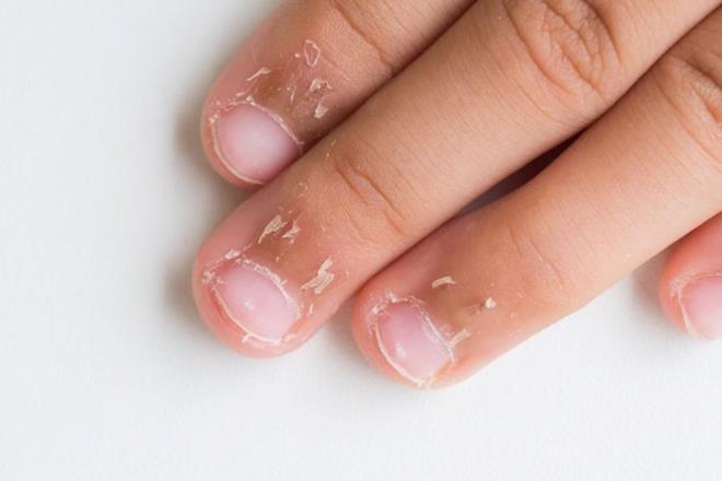 Enfeksiyonlar: Trnak mantar veya baka enfeksiyonlar, trnak plakasnda beyaz lekelerin olumasna yol aabilir.    Kimyasal Maddelere Maruz Kalma: Agresif kimyasallar veya temizlik maddeleri trnak yzeyini etkileyebilir ve beyaz lekelerin oluumuna neden olabilir.