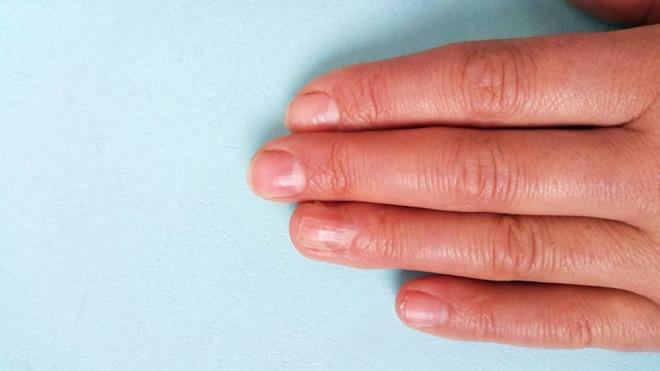 Dier Salk Sorunlar: Nadir durumlarda, trnaklarda beyaz lekeler ciddi salk sorunlarnn belirtisi olabilir, ancak genellikle dier semptomlarla birlikte ortaya kar.    Genellikle trnaktaki beyaz lekelerin vitamin eksikliinden kaynakl olduu dnlr. Ancak durum yalnzca bundan ibaret deil! Mantar enfeksiyonu dahil pek ok neden trnaklarda beyaz lekeye sebep olabiliyor.