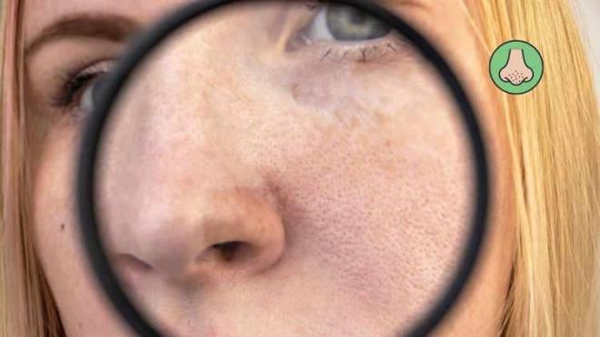 Beslenme ve hormanel deiiklikler sonucunda gzenekler tkanarak zamanla siyah nokta olumasna sebep olabilir.te siyah noktalar temizleyen yntemler...