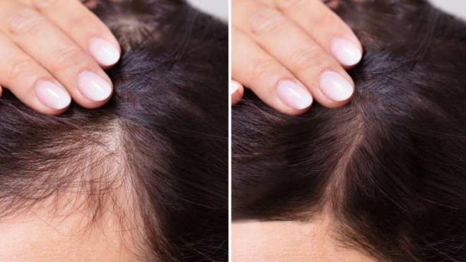 Sa dklmesi ou zaman dzensiz ve yetersiz beslenme, stres, hareketsizlik gibi sebeplerle ya da genetik faktrlerle birlikte ortaya kmaktadr. Ancak uzmanlar bu durumun yalnzca bu sebeplerle deil vcudunuzdaki vitamin eksikliinden dolay da yaanabildiini sylyor. Eer siz de sa dklmesi yayorsanz vcudunuzda bu vitaminlerin eksik olmadndan emin olun. te eksiklii sa dklmesine sebep olan vitaminler ve mineraller...