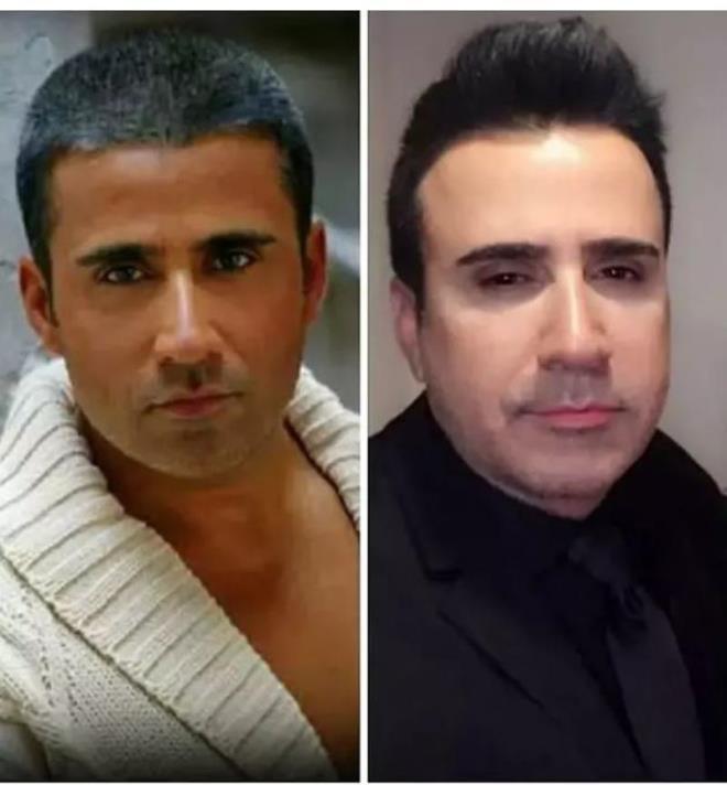 Botoks ve dolgu operasyonlaryla gndeme gelen Emrah ten rengindeki deiimle de dikkatleri ekiyor.