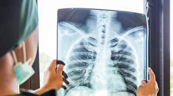 AKCER'DE LTHABA NEDEN OLUYOR    Baay yle konutu:Akcier hastal olmasa bile kfn ortamda bulunmas enfeksiyonlara zemin hazrlar, kiinin baklk sistemini drr.