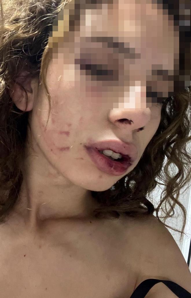 "HER AN HER EY YAPABLR"    S.A., "Kapya ynelip, elinden kurtulmaya almak isteyince Hseyin yine dvmeye devam etti. Tabii bu sre 7-8 saat devam etti ve sabah oldu. Hseyin, 'Otur oturduun yerde seni brakmam bekle' dedi. 'Yeter artk beni bir yere gtr' dedim. Azm, burnun kan iindeydi. Sonra yurduma brakt. Brakrken 'Polise ikayet etmeye kalkma. Benim arkam kuvvetli, eline hibir ey gemez. Torpidomda 35 bin lira param vard, onlar ald. Kendi kendisini bu hale getirdi derim' dedi. Daha sonra savcla gittim, darp raporu aldk ama savclk serbest brakt. Ve u anda hibir ekilde bir korumam, herhangi bir eyim yok. Hala serbest. Her an her eyi yapabilir" diye konutu.