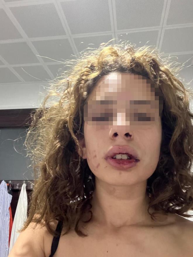 "BU KARAR VCDANLARI DERNDEN YARALAMITIR"    S.A.'nn avukatlarndan Muhammet ar Trk, "Mvekkilimiz tedirgin bir haldeydi. ikayeti olmaktan da tedirgindi, korkuyordu. nk bir gece boyunca ikenceye maruz kalmt. ikayeti olduktan sonra pheli ve phelinin ailesi tarafndan ikence grmekten korkmaktayd. Mvekkille birlikte hastaneye gittik, raporlarn aldk ve darbedildikten sonraki fotoraflaryla birlikte savcla bavurduk. phelinin eylemlerinin ierisinde 4-5 farkl suun olduunu grmekteyiz. Gece boyunca mvekkili tehdit etmi, hakaretlerde bulunmutur. Mvekkili yaralam, gece boyunca da evinde zorla tutarak kiiyi hrriyetinden yoksun klma suu olumutur. Mvekkilin telefonu ve czdanna da el koyarak yama suunu ilemitir. Burada bu kadar su tipini barndran ve gece boyunca mvekkile ikencede bulunan phelinin burada adli kontrol ile serbest braklmas gerek mvekkilin gerekse toplumun vicdann derinden yaralamtr" dedi.    "DOSYANIN TAKPS OLACAIZ"    S.A.'nn avukatlarndan Furkan Avc ise "Mvekkilin gerek kanl kyafetleri gerek pheli tarafndan ikrar edilen mesaj olsun, gerek darp raporu olsun, phelinin mvekkile kar su iledii sabit olmasna ramen adli makamlar tarafndan adli kontrol karar verilmesi karsnda mvekkilimizin hukuki mcadelesinde srekli yannda olacaz. Gerekli itirazlarmz yapacaz ve dosyann takipisi olacaz" diye konutu.